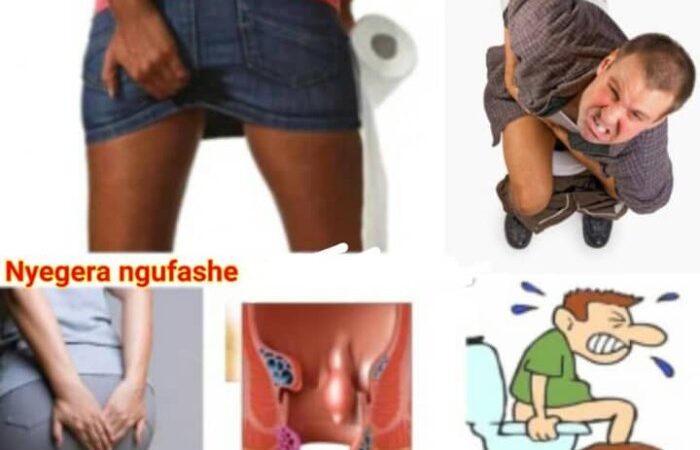 Sobanukirwa ibiteye inkeke n’amatsiko ku ndwara ya EMOROYIDE n’uko wayirinda