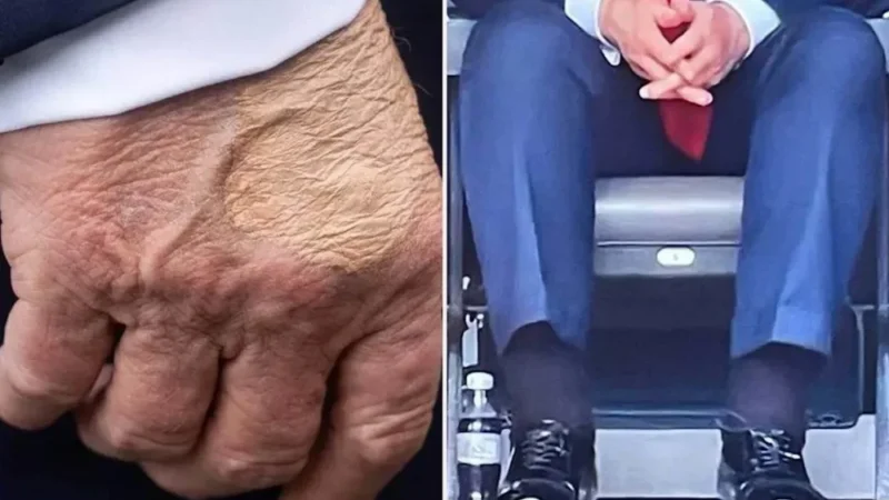 Perezida Donald Trump yagaragayeho indwara y’imitsi