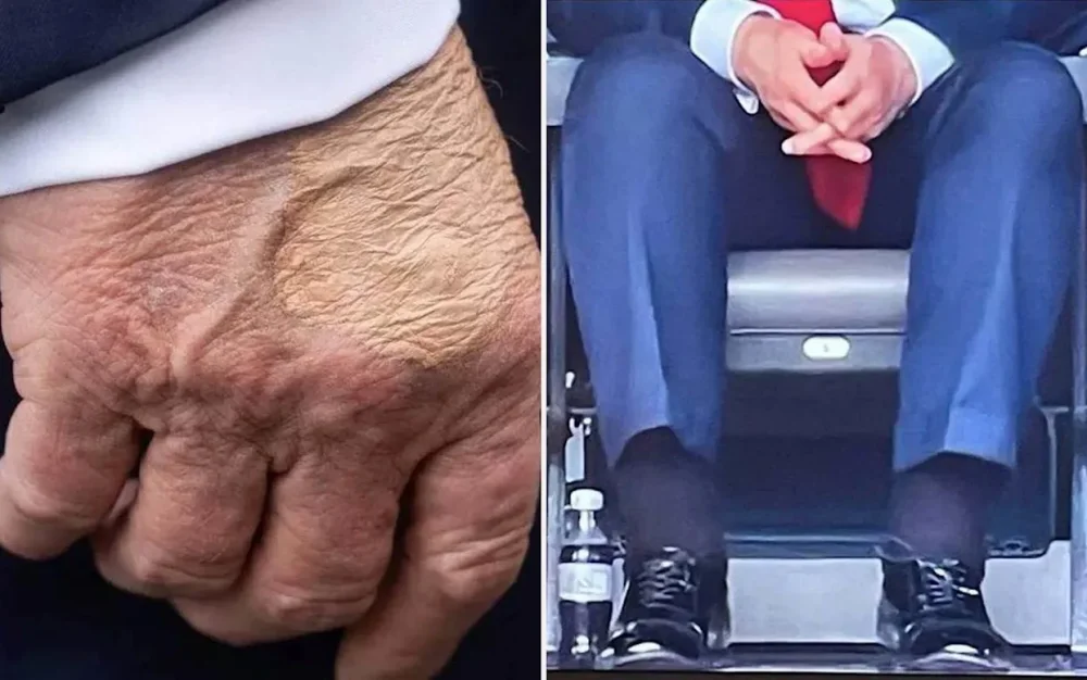 Perezida Donald Trump yagaragayeho indwara y’imitsi